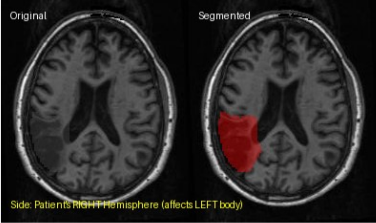Aamazing Brains - AI Stroke Detection Interface